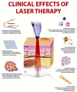 Laser Therapy BioFlex | 101 Osteopathic Centre | GTA Healer